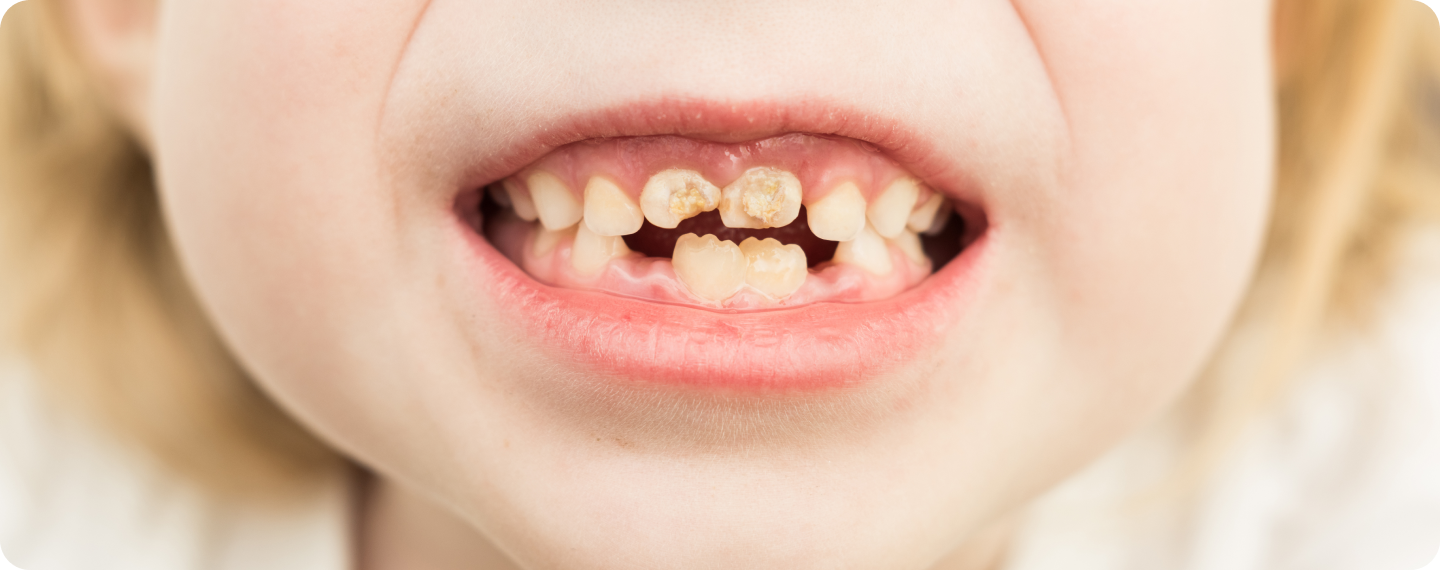mih lanative MIH La Native | Orthodontie & Pédodontie
