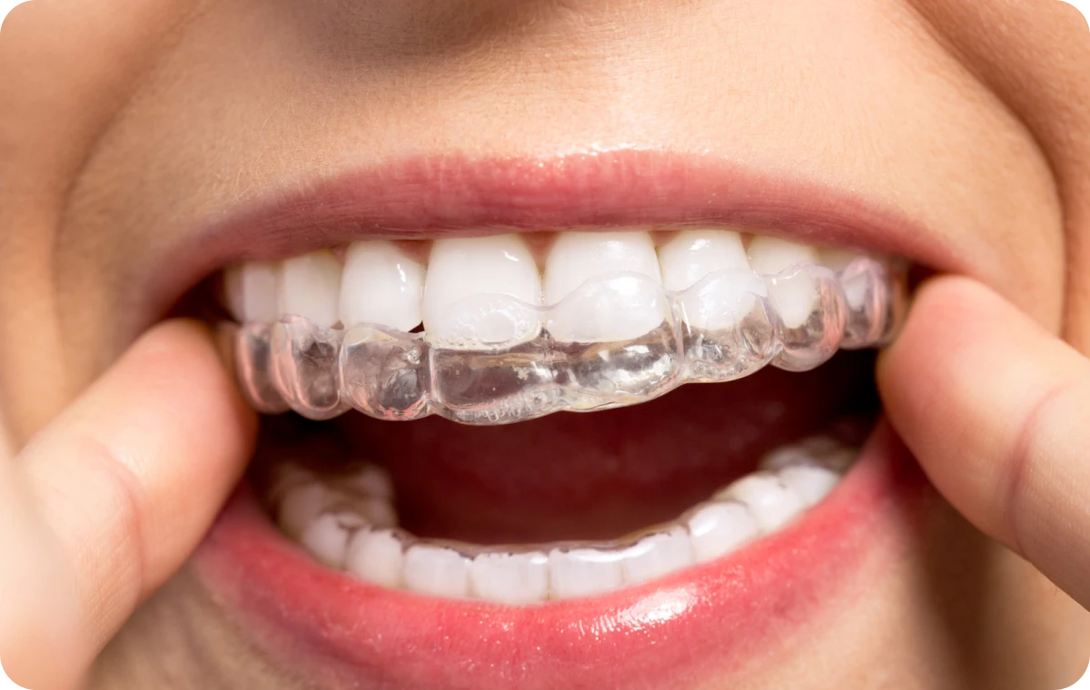 aligneurs invisibles la native Gouttières invisibles La Native | Orthodontie & Pédodontie