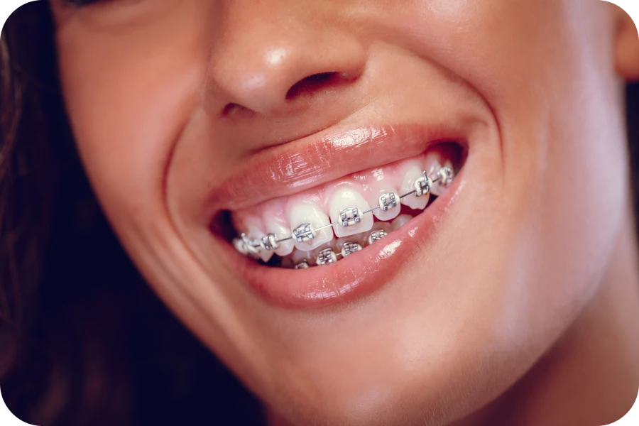 bagues traitement la native Espace entre les dents La Native | Orthodontie & Pédodontie
