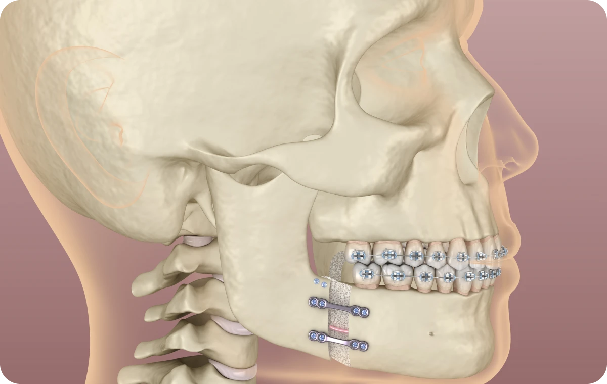 chirurgie orthognatique aix en provence Orthodontie chirurgicale La Native | Orthodontie & Pédodontie