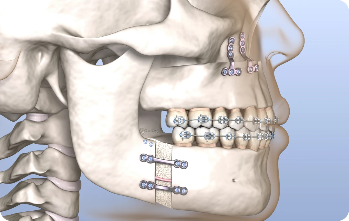 chirurgie orthognatique la native Orthodontie chirurgicale La Native | Orthodontie & Pédodontie