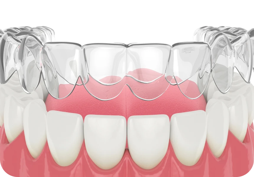 contention amovible la native Contention La Native | Orthodontie & Pédodontie