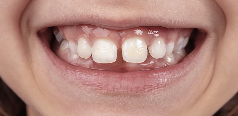 contention bouc bel air Espace entre les dents La Native | Orthodontie ; Pédodontie