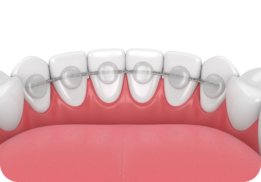 contention fixe la native Contention La Native | Orthodontie & Pédodontie