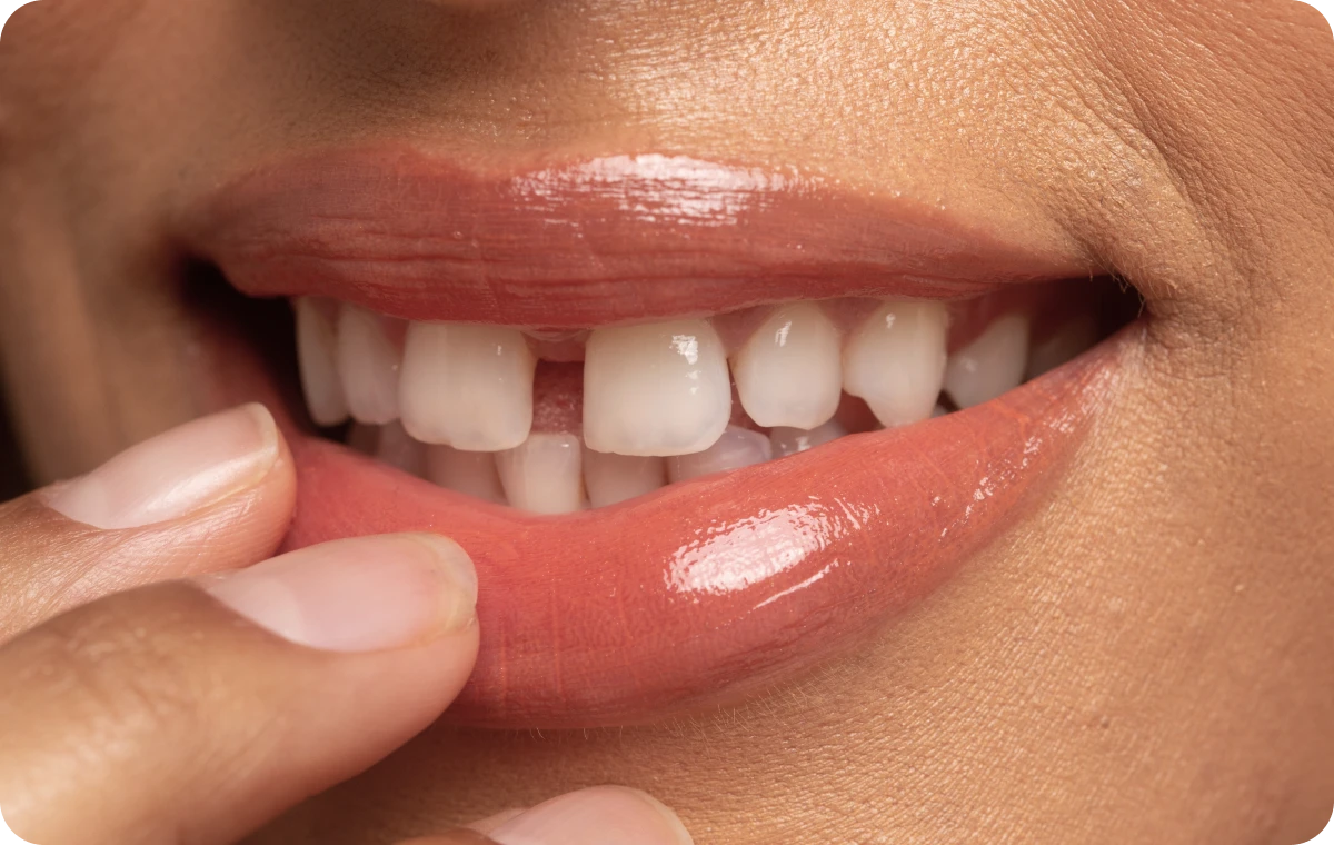 dents ecartees pathologie la native Espace entre les dents La Native | Orthodontie & Pédodontie