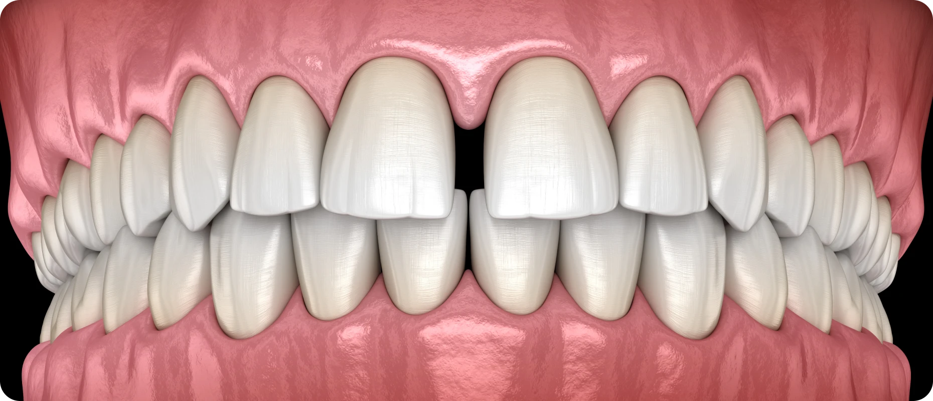 diasteme la native Espace entre les dents La Native | Orthodontie & Pédodontie