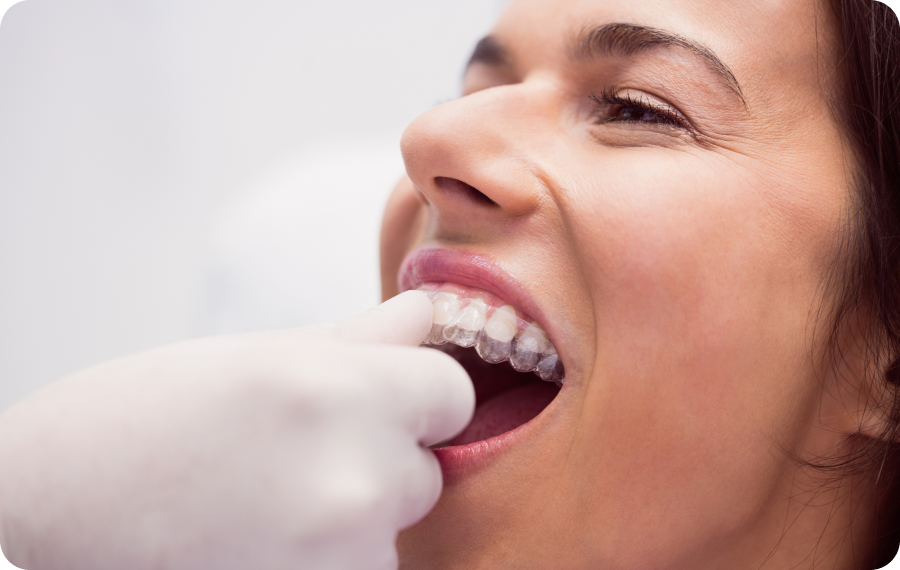 gouttiers envisibles pathologies problemes esthetiques dentaires la native Problèmes esthétiques dentaires La Native | Orthodontie & Pédodontie
