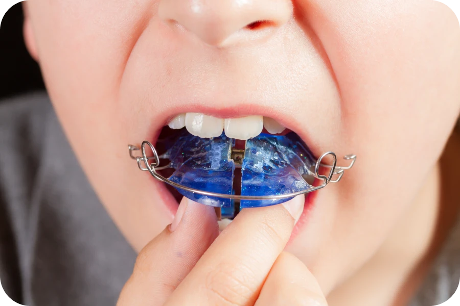 orthodontie enfant la native Orthodontie précoce La Native | Orthodontie & Pédodontie