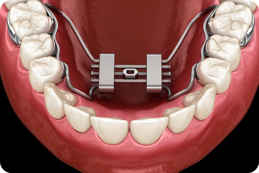 orthodontie precoce la native Orthodontie précoce La Native | Orthodontie & Pédodontie