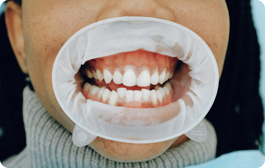 orthodontiste orthodontie avancee bouc bel air Problèmes esthétiques dentaires La Native | Orthodontie & Pédodontie