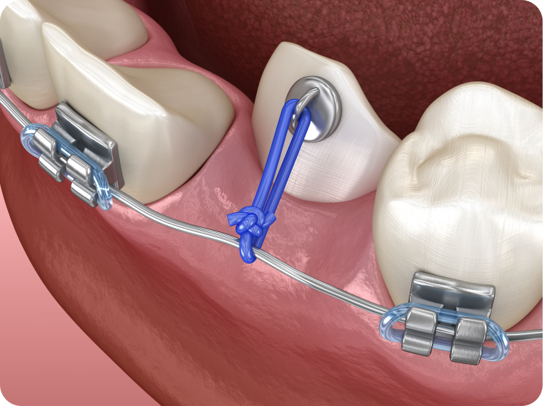 orthodontiste specialiste bouc bel air Dents impactées La Native | Orthodontie & Pédodontie