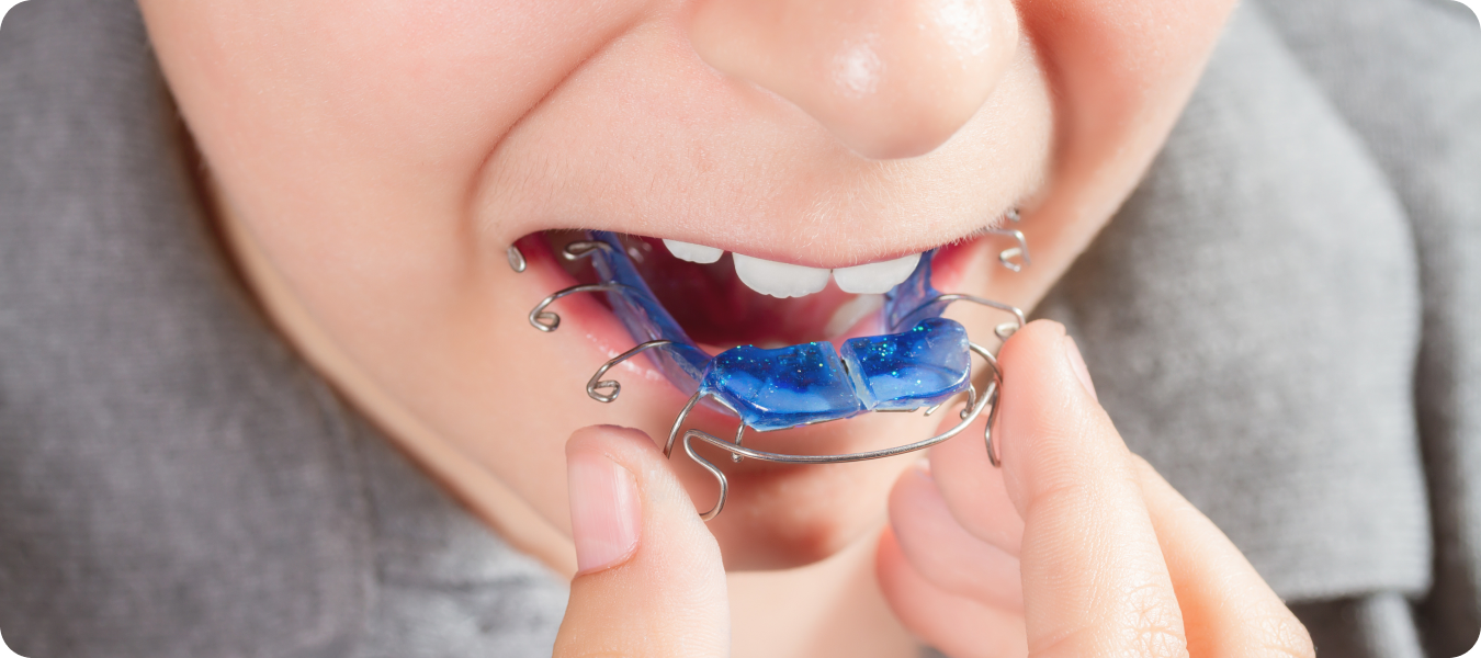 palatine pathologies Apnée du sommeil La Native | Orthodontie & Pédodontie