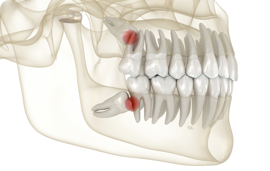sagesse pathologies dents impactees la native Dents impactées La Native | Orthodontie & Pédodontie