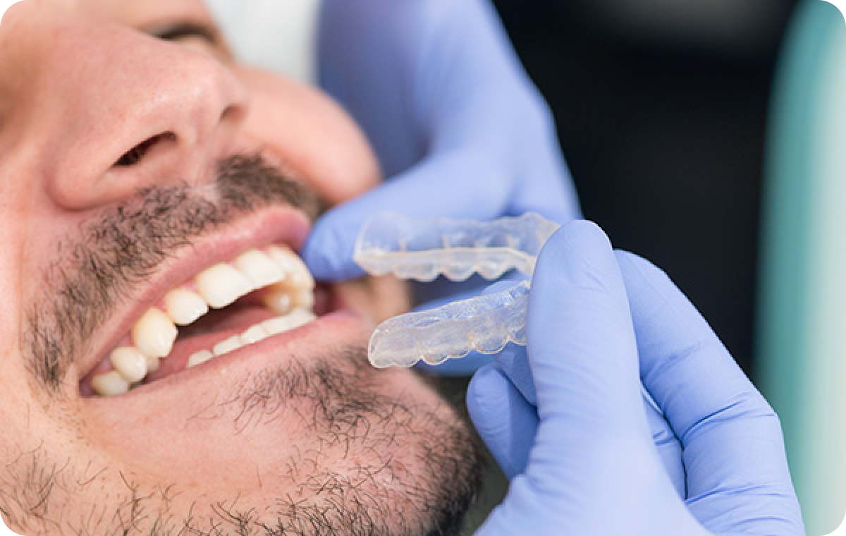 pose appareil dentaire orthodontiste Gouttières invisibles à Cabriès-Calas La Native | Orthodontie & Pédodontie